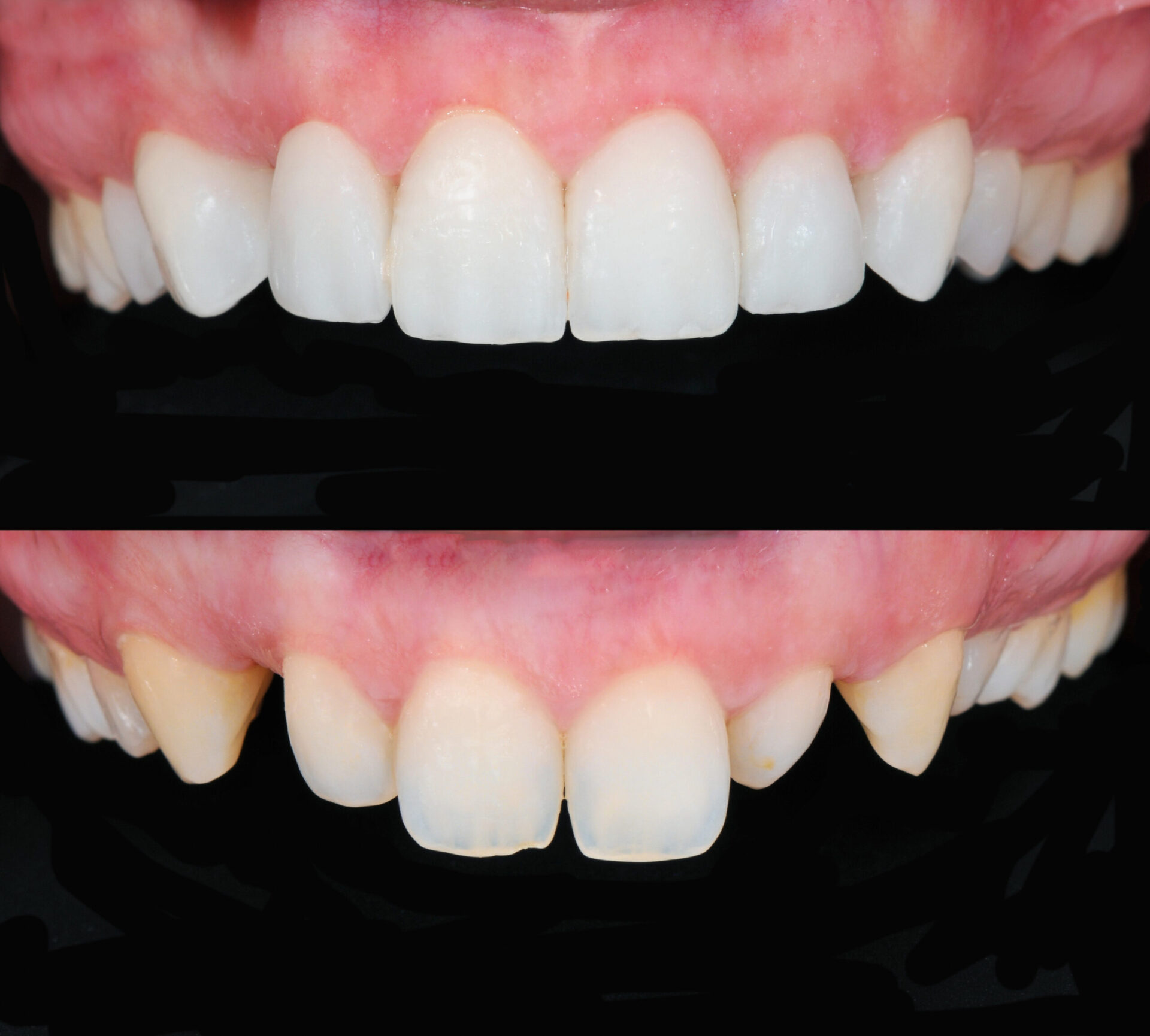 Zahnersatz kronen vorher nachher