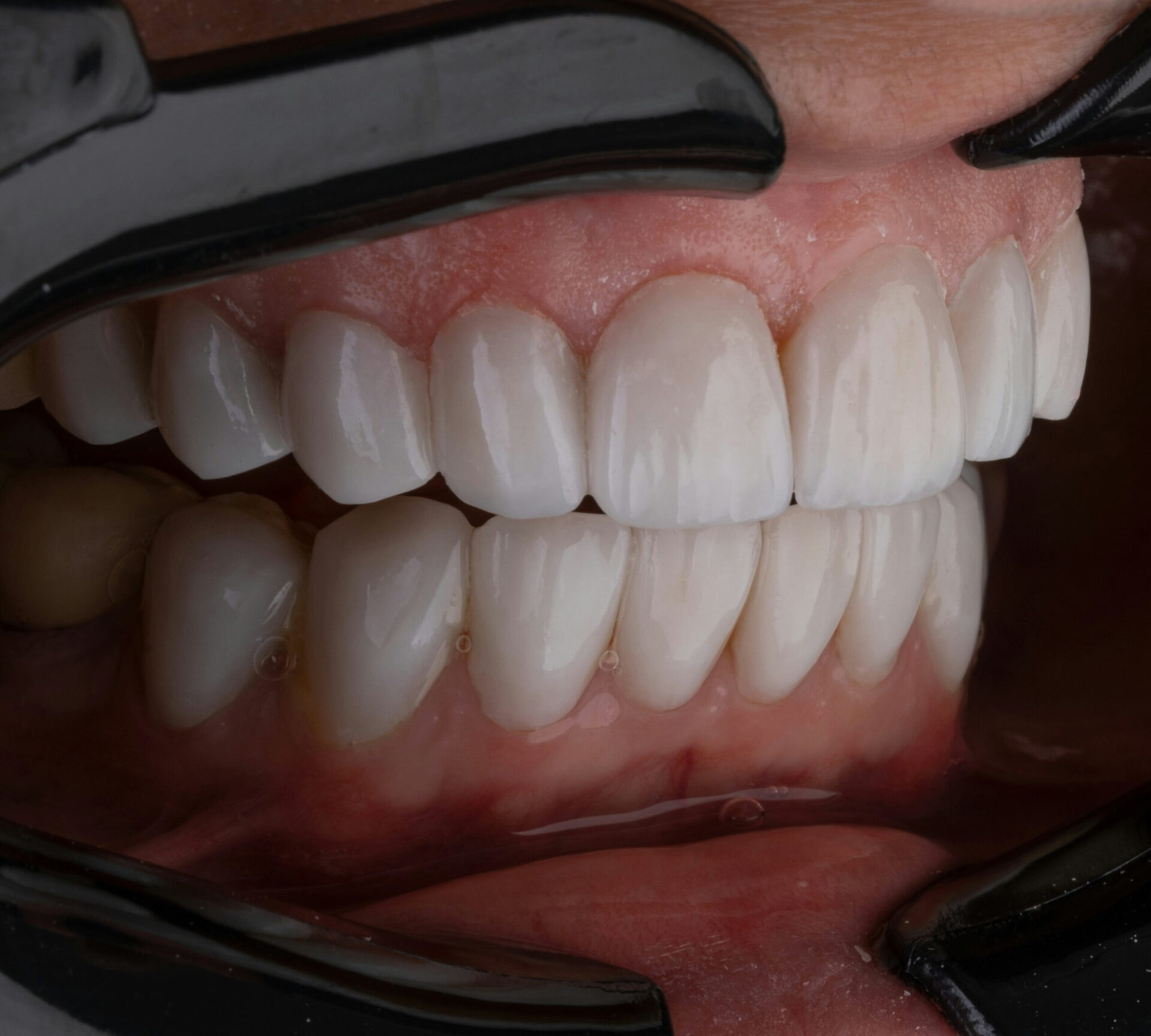 Zahnersatz kronen vorher nachher