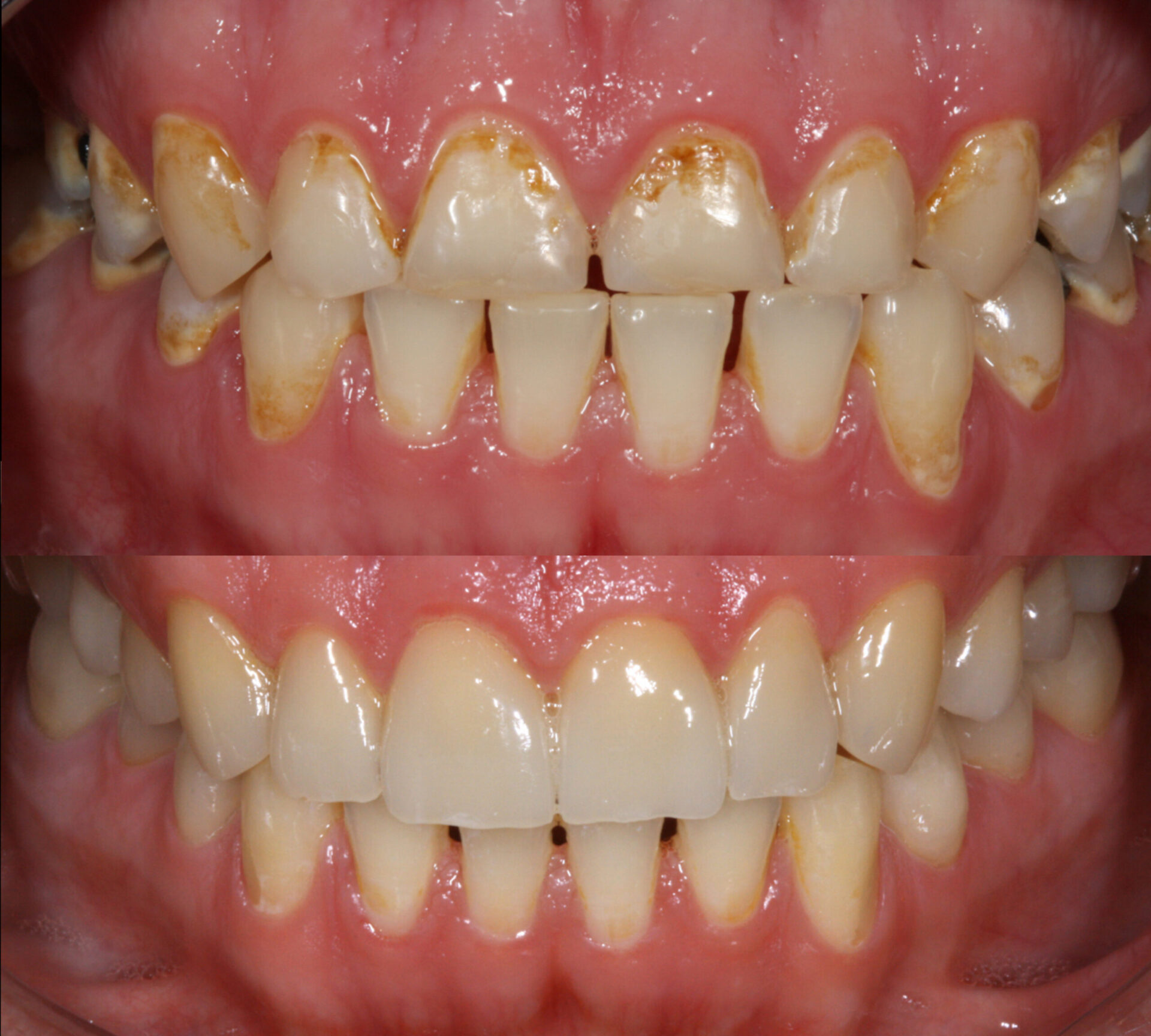 Zahnersatz kronen vorher nachher